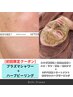 【相乗効果UP♪】プラズマシャワー×ハーブピーリング　人気セット☆ 11500円
