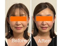 サロンベイビー 尼崎塚口店(Salon Baby)/【小顔美容整顔】Before・After