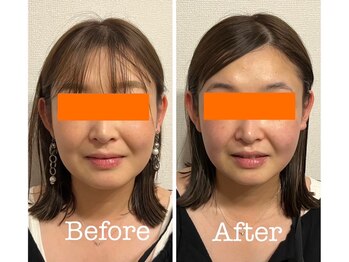 サロンベイビー 尼崎塚口店(Salon Baby)/【小顔美容整顔】Before・After