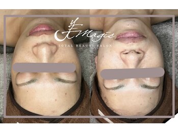 ビーマジック(美magic)/ララピール症例