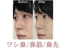 ラプリボヤージュ 藤沢店(Raplit)/ 隆鼻＋輪郭40分