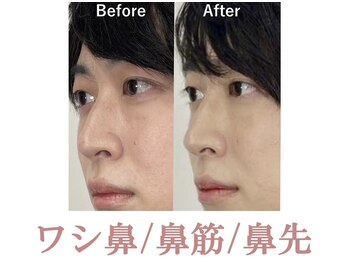 ラプリボヤージュ 藤沢店(Raplit)/ 隆鼻＋輪郭40分