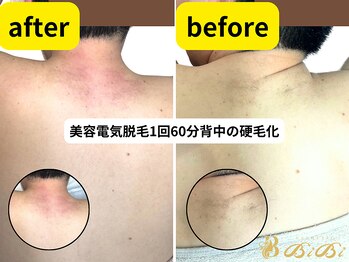 エステビビ 町田店(エステBiBi)/硬毛科には美容電気脱毛！