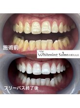 ホワイトニングサロン 京都烏丸店/ホワイトニング施術例