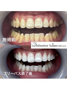 ホワイトニングサロン 京都烏丸店/ホワイトニング施術例