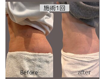 ウナ 福岡店(UNA)/モニター様★ウエスト4cup 