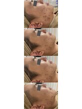 ルミラポー(Lumira Peau)/シミ集中ケア＋肌質改善