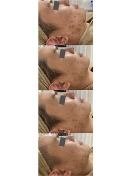 ルミラポー(Lumira Peau)/シミ集中ケア+肌質改善