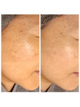 エリン(ERIN)/セラピール