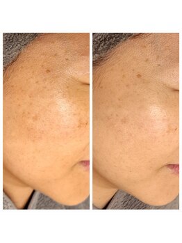 エリン(ERIN)/セラピール