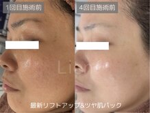 リアン/テラボーラーお肌の変化実感例