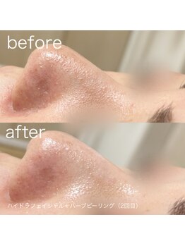 ルルラ リコ(lulula rico)/症例写真/ハイドラ毛穴洗浄