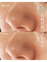 モエラビューティーサロン(Moela beauty salon)/【全顔毛穴洗浄】
