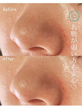 モエラビューティーサロン(Moela beauty salon)/【全顔毛穴洗浄】