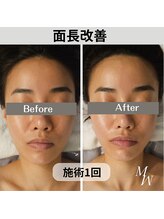 ミピマム/【コルギ】整形されていてもOK