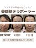 お試し★顔の筋トレ　テラボーラー1回+テラパック付☆￥15,000→￥7980