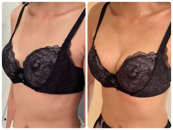 オリーブ 金沢(Olive)/バストアップ★育乳症例