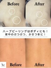 ベル 明大前(Belle) 背中 ニキビケア