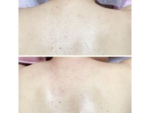 ルル(RuRu)/ Wax脱毛