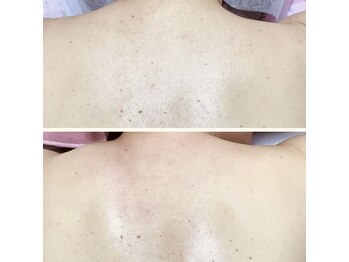 ルル(RuRu)/ Wax脱毛