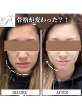 パールリフト 小田原店/小顔と毛穴ケアで美肌革命