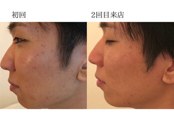 ワイスタイル(Ystyle)/初回から2週間後