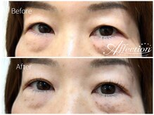 アフェクション アイビューティー(Affection eye beauty)/