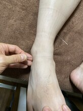 ジェネ鍼灸院/動きの悪い足首に