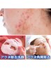 ≪ニキビケア繰り返す肌荒れが悩みの方≫全顔毛穴洗浄+ニキビケア　/¥9,800→