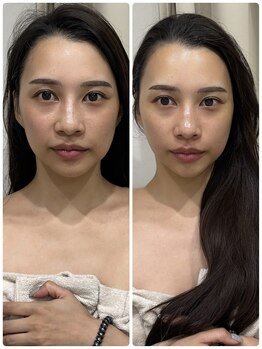 メディカルエース(MedicalAce)/ハイサーマ