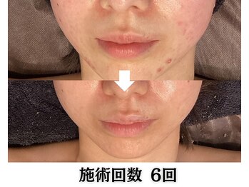 ハーブピーリング&毛穴洗浄専門店 肌REVO 高田馬場店[ニキビ/毛穴/たるみ/美白/シミ]/ハーブピーリング/ニキビケア