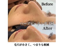 エムラボ 新宿店(M LABO)/国産ハーブピーリング