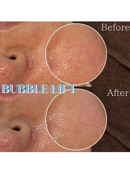 肌管理-SIASKIN-【4/1 NEW OPEN（予定）】の写真/【乾燥・ハリ・ニキビケア】乾燥こそ、すべてのお肌トラブルの始まり。水玉リフティングLDMで水分量UP◎