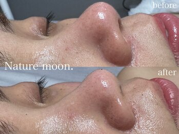 ナチュールムーン(Nature moon.)/毛穴洗浄