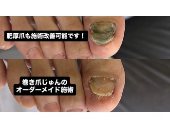 巻き爪じゅん 千葉駅前店の写真/【千葉駅徒歩2分】爪のお悩み改善・フットケア専門店!高技術×お手頃価格でツルツルのかかとへ★