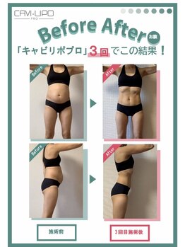 ジュリス(JURIS)/最新痩身マシン・キャビリポプロ