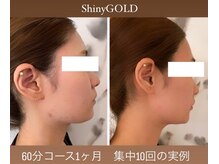 シャイニーゴールド 新所沢店(Shiny GOLD)/欲張り小顔フェイシャル