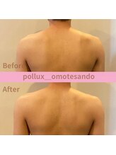 ポルクス鍼灸整骨院 表参道(Pollux鍼灸整骨院)/EMS ビフォーアフター