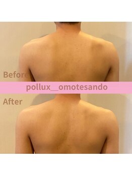 ポルクス鍼灸整骨院 表参道(Pollux鍼灸整骨院)/EMS ビフォーアフター