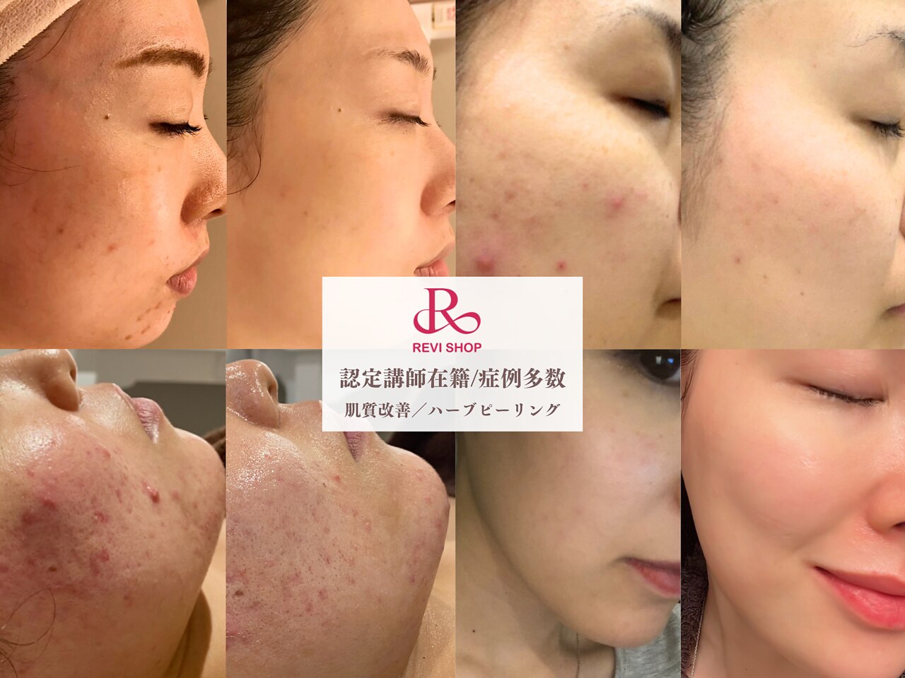 REVI ハーブピーリング 大阪に関するエステサロン 心斎橋 REVI REVI ハーブピーリング 大阪に関するエステサロン 心斎橋 REVI