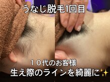 リエル(RIEL)/【うなじ脱毛】