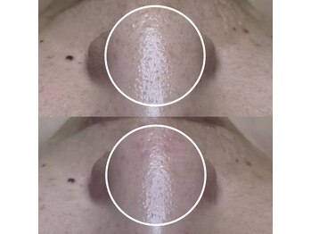 ビオルブ(VIOLVE)/ハーブピーリング&毛穴洗浄