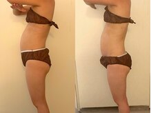 ヒールパーム(Heal Palm)/ウルトランスフォーマー1回★