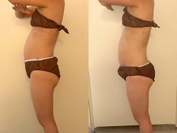 ヒールパーム(Heal Palm)/ウルトランスフォーマー1回★