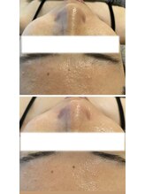 エヌ(enu)/プラズマ/フェイシャル