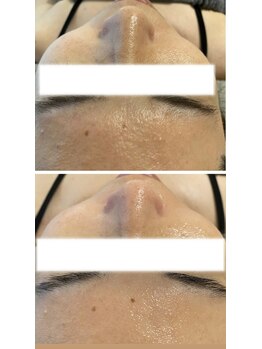 エヌ(enu)/プラズマ/フェイシャル