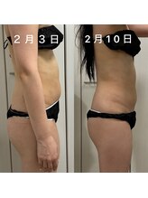 リノ ポノ(Lino Pono)/腹部レッドショット2回目の効果