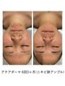 【ニキビ集中改善セット】¥19000→¥12000!繰り返すニキビに本気の結果出し◎