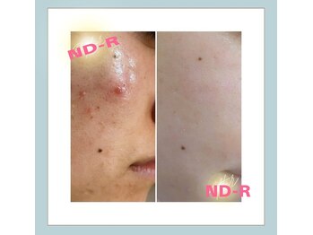 痩身 フェイシャル専門店 ビューティーサロン モアナ(beauty salon moana)/【今話題】最先端チクチク美容！