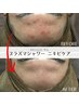 男女【肌トラブル全般】プラズマシャワー＋毛穴ケア+ソニック導入 体験13200